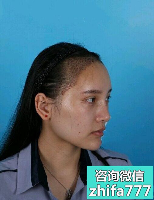 海口碧莲盛发际线种植，毛发非常稳固