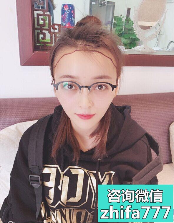 成都恒博发际线种植，半年的效果好好