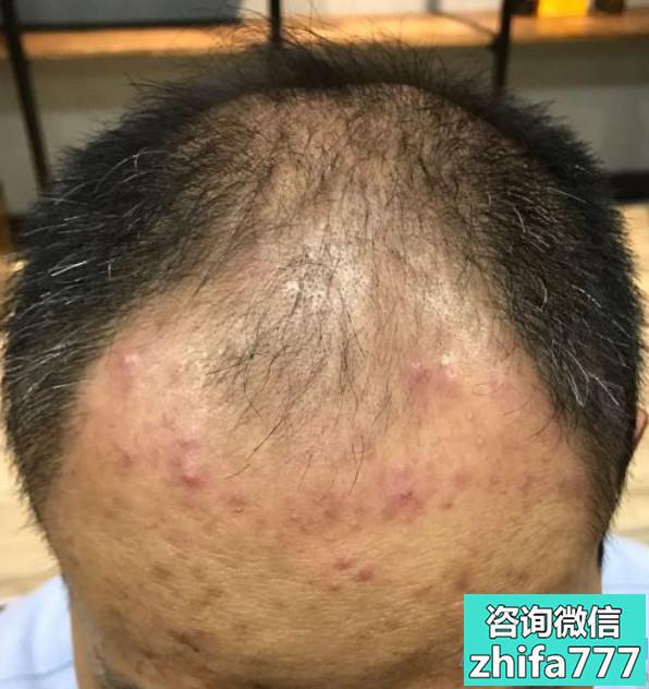 上海莱森秃顶植发，半年效果很好