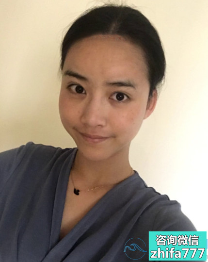 重庆时光发际线种植，终于告别大脑门了