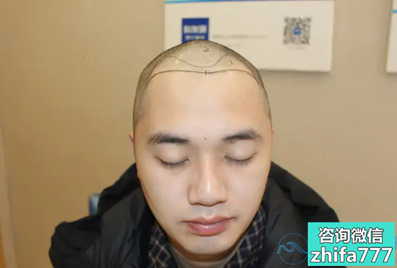 贵阳美贝尔头顶加密种植，头发很自然