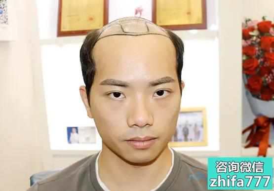 北京新生秃顶植发让我变帅了