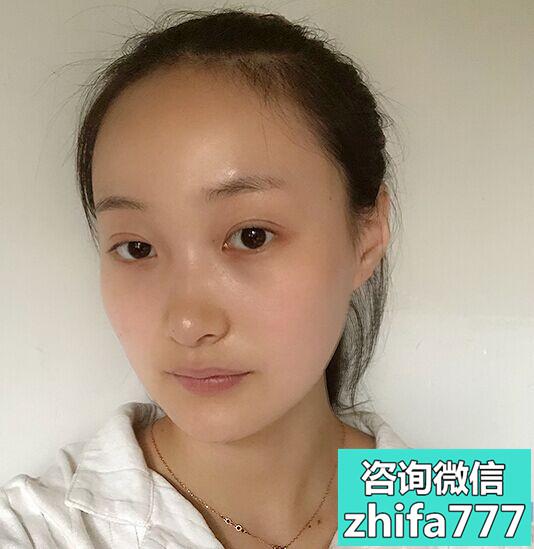 长沙爱思特发际线种植效果棒棒的