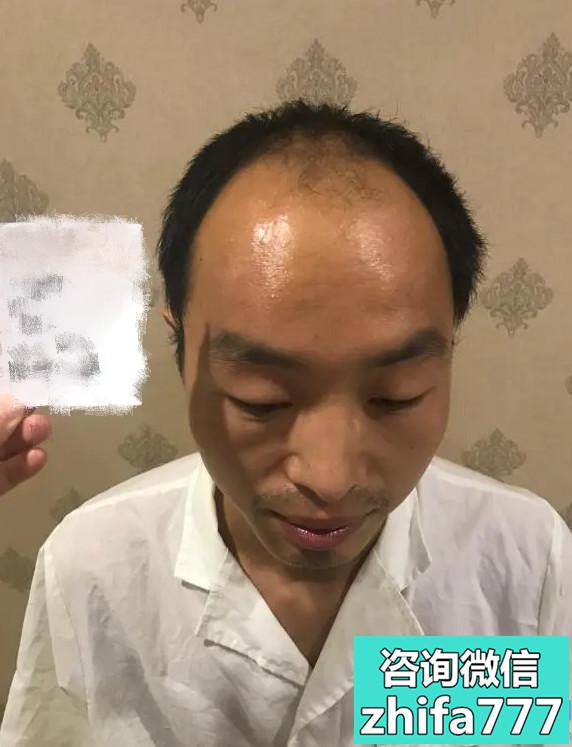 长春珍妮头顶加密种植比以前精神多了