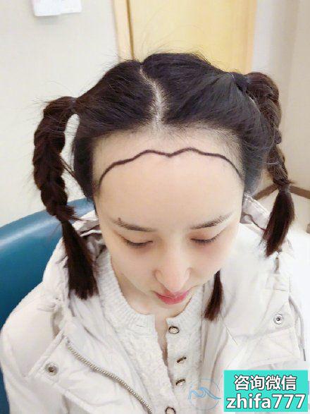 上海华山美人尖种植最终效果来啦