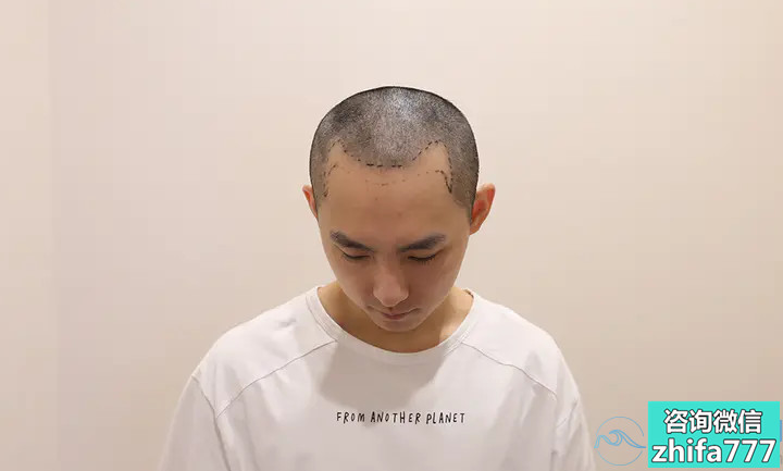 杭州薇琳发际线种植长势很不错