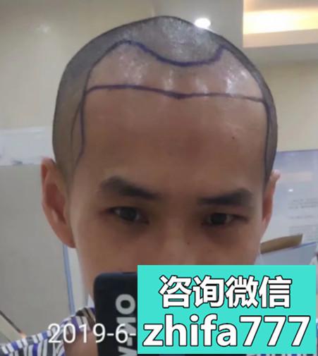 广州雅度发际线种植咋样