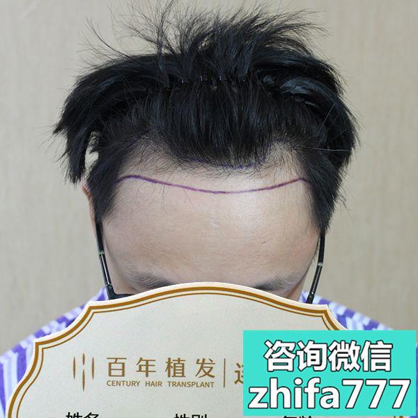 无锡百年发际线种植术后分享