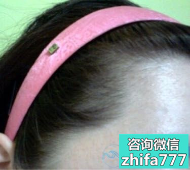 青岛瑞丽诗发际线种植效果怎么样