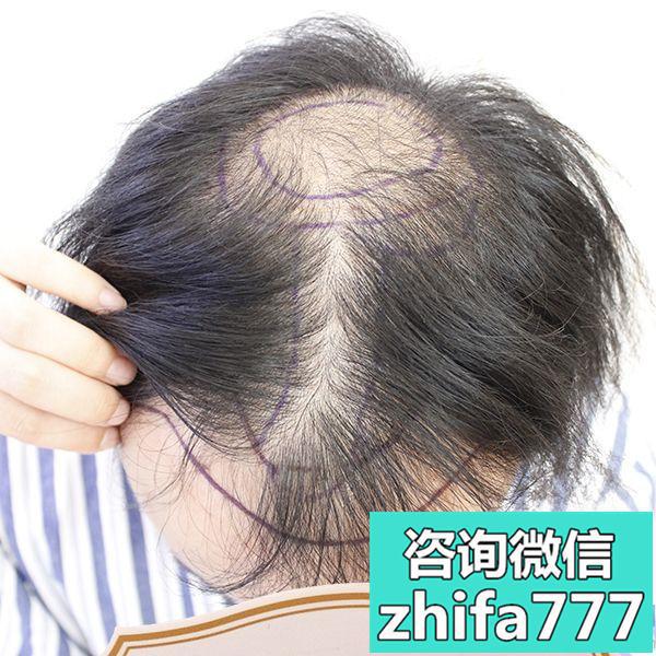 无锡百年头顶加密种植都说我年轻了