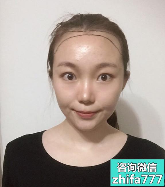 深圳鹏程发际线种植术后效果非常自然