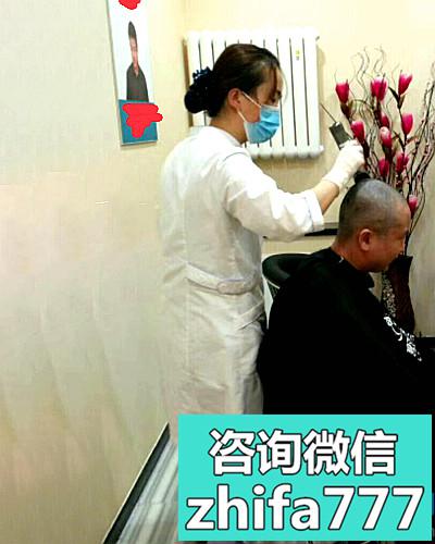 合肥曙光发际线种植术后效果咋样