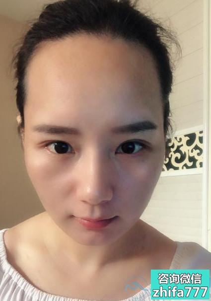南京碧莲盛发际线种植很满意