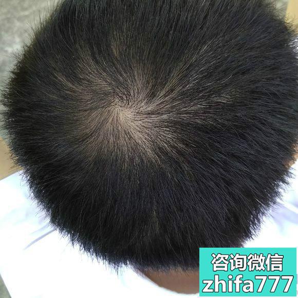 烟台华美头顶加密种植非常满意