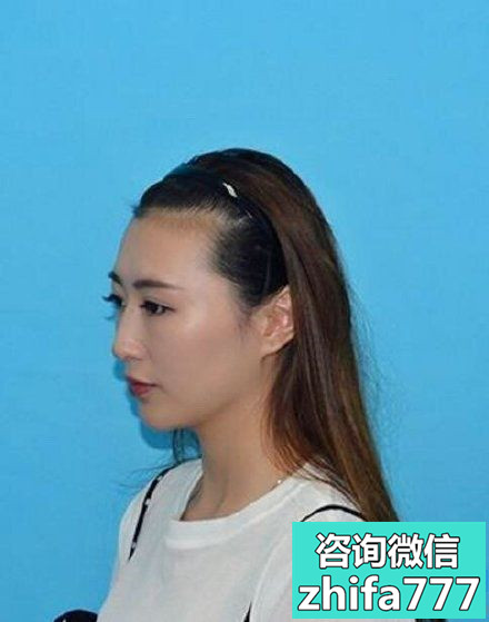 南宁碧莲盛发际线种植美美的