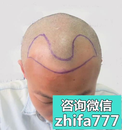 大连碧莲盛发际线种植术后效果咋样