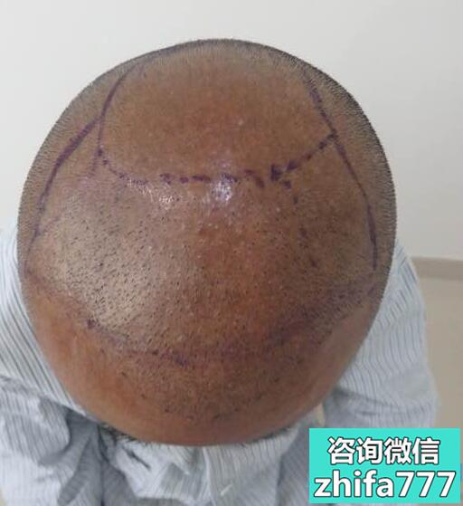 西安熙朵头顶加密种植术后分享