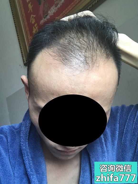 重庆艺星秃顶植发术后效果分享