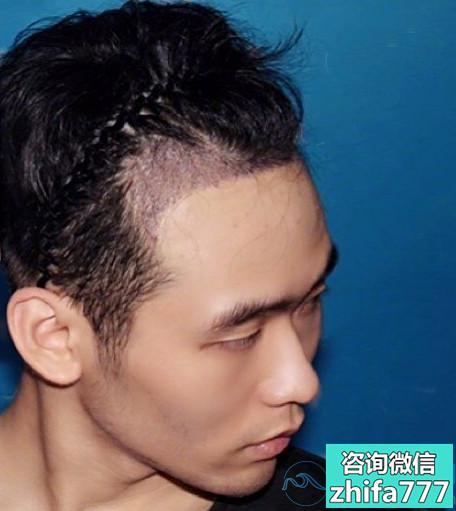 顺德壹加壹发际线种植非常满意