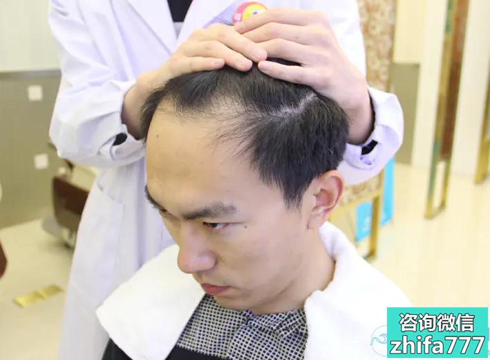 天津熙朵稀少加密种植术后效果咋样