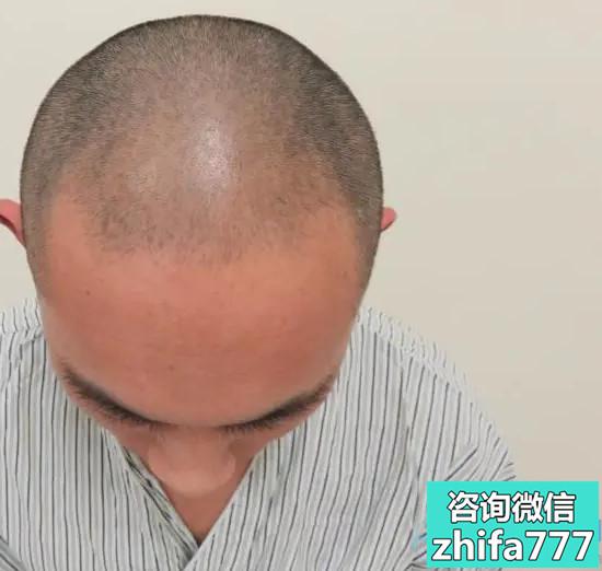 石家庄大麦稀少加密种植，植发很成功