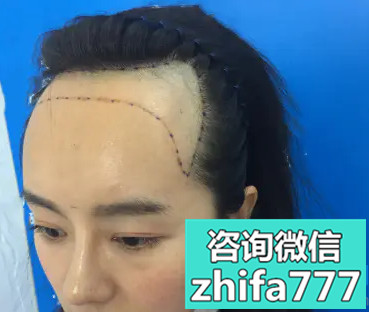 深圳碧莲盛发际线种植术后分享