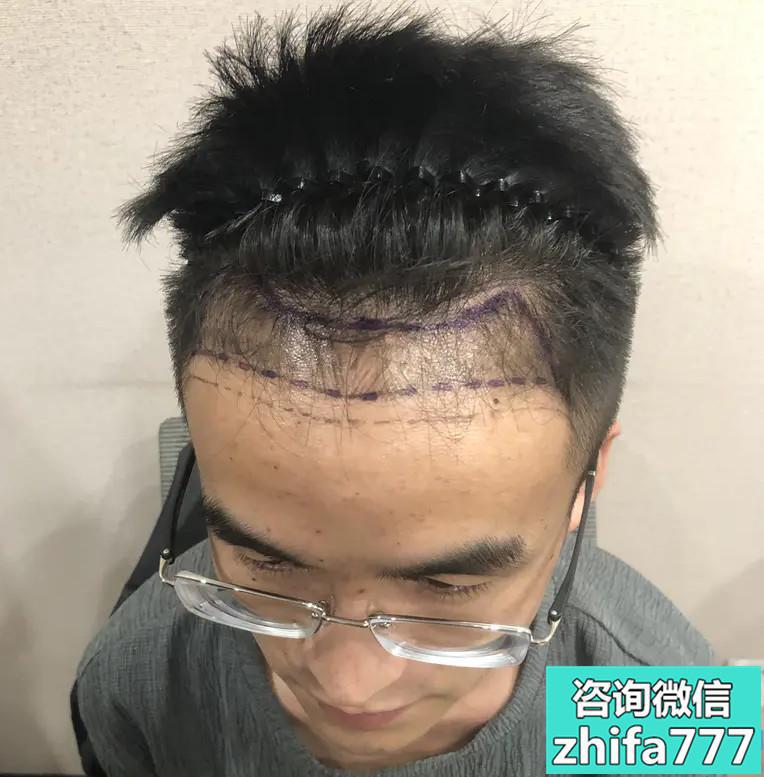 济南大麦发际线种植植发效果如何