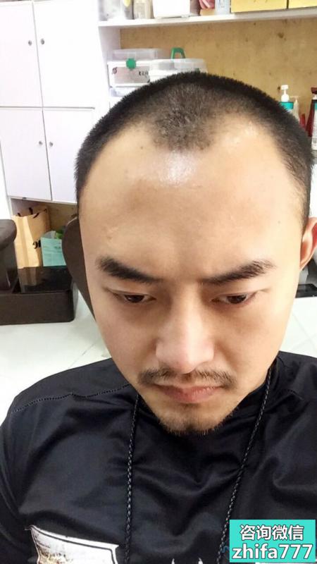 上海首尔丽格发际线种植怎么样