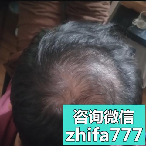 天津联合丽格头顶加密种植怎么样