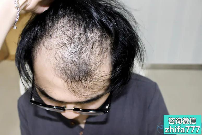 兰州碧莲盛秃顶植发效果怎么样