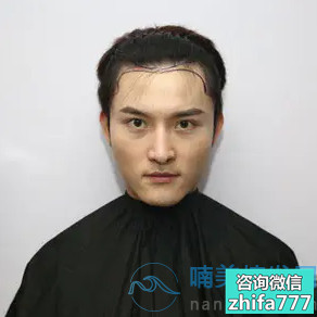 成都新生发际线种植术后分享