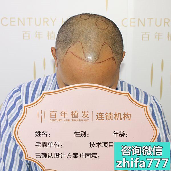 无锡百年发际线种植让我自信了