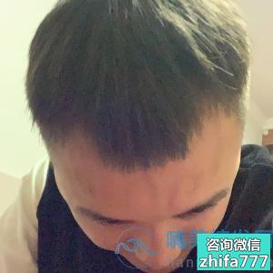 昆明艺星发际线种植，成活率很不错