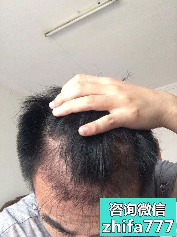 南京艺星发际线种植术后分享