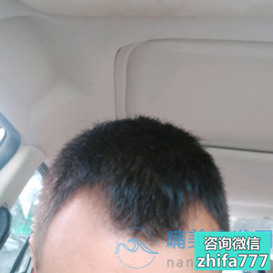 柳州华美发际线种植案例分享