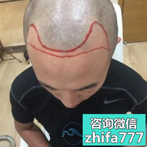 北京薇琳发际线种植，植发很成功