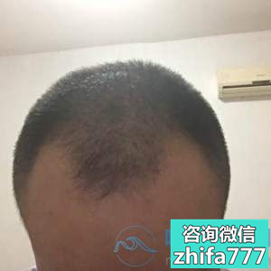 合肥曙光发际线种植案例分享