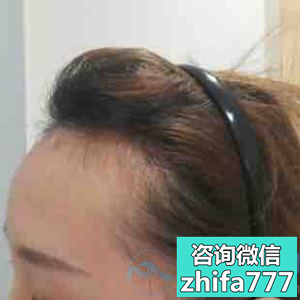 苏州圣爱发际线种植，终于可以大胆的露额头啦