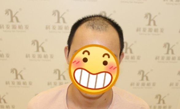 脱发是我每天的噩梦