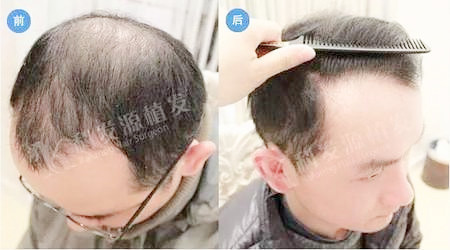 M型O型脱发前后夹击怎么办植发2712单位