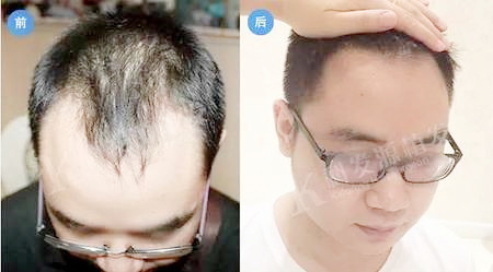 脱发怎么办植发2060单位11个月逆袭