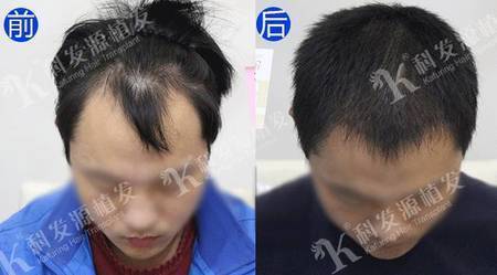 遗传脱发前额微针植发终扬眉吐气