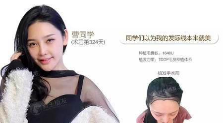 她发际线后移种植1640单位后很媚很美