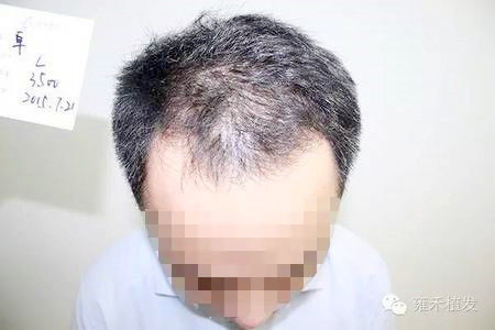 男性头顶植发3500单位6个月效果
