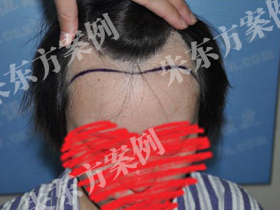 妞妞兔兔国庆植发记2670单位