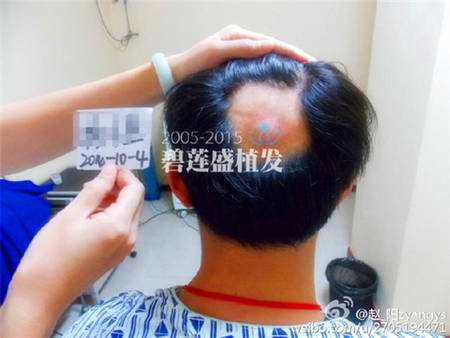 疤痕植发终于能结束自卑的心理了畅快