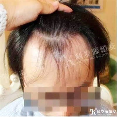 头发种植后的效果太可怕了