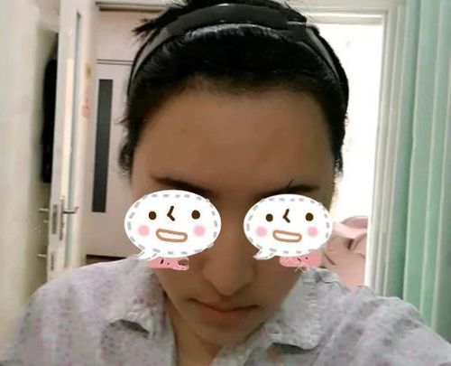 北京植发案例美女发际线太高很尴尬