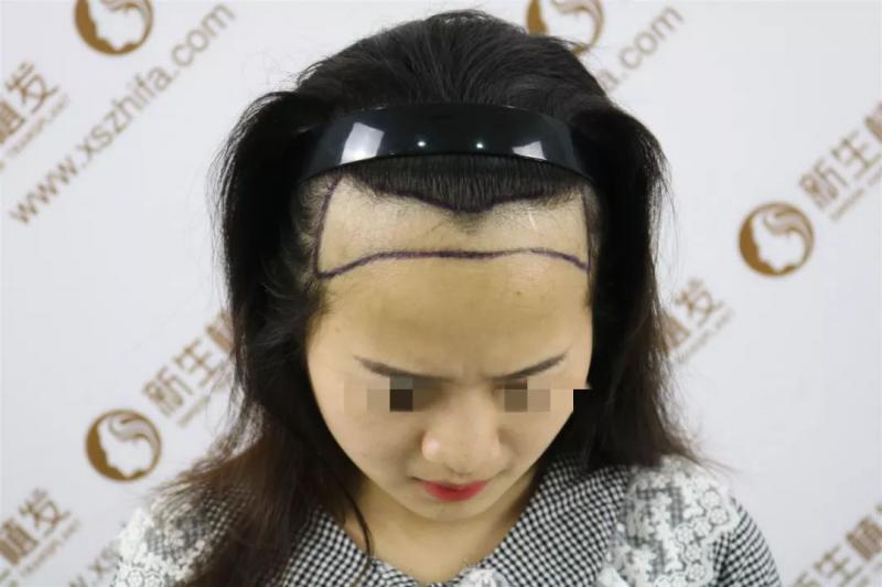 发际线种植1800单位发际线前移美出新高度！