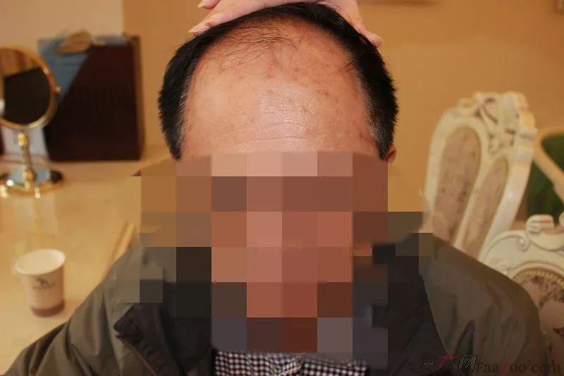 成都植发术后9个月感恩回馈